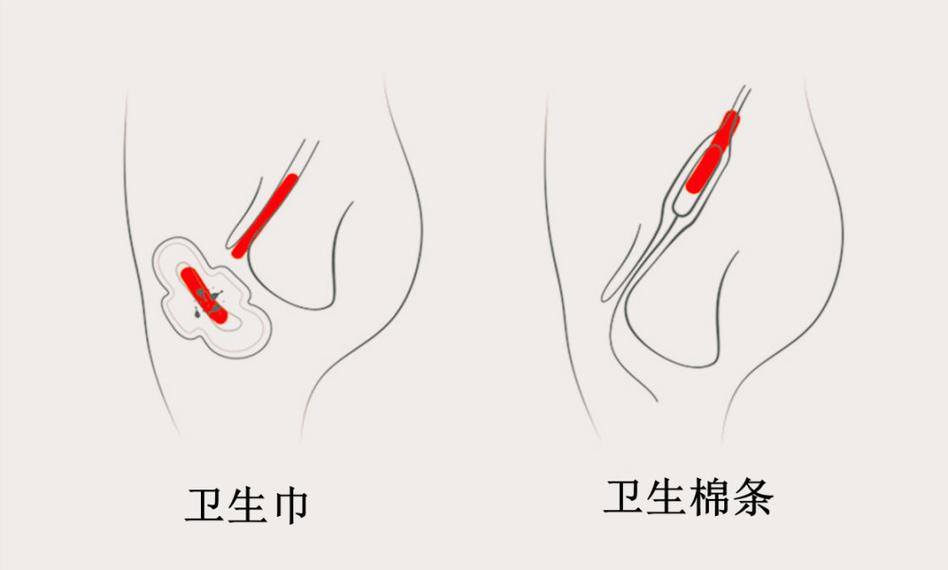 棉条和卫生巾哪个更好（哪个更适合你）